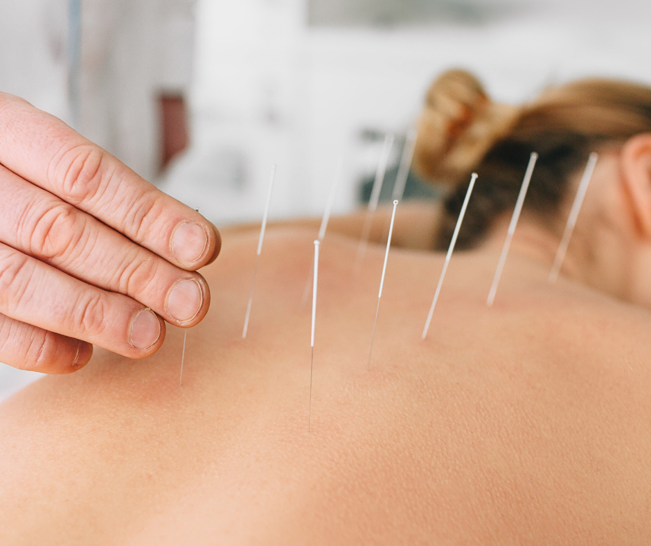 Acupuncture