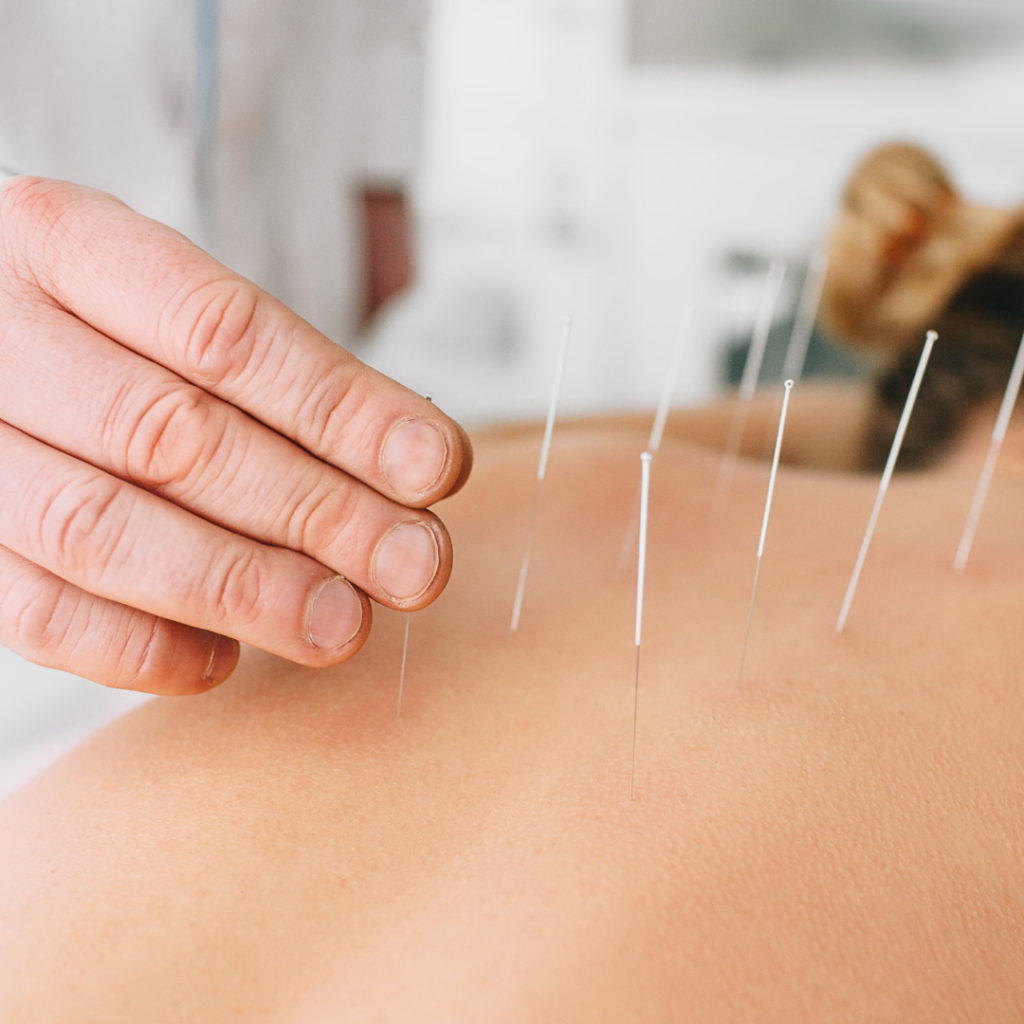 Acupuncture in Amityville